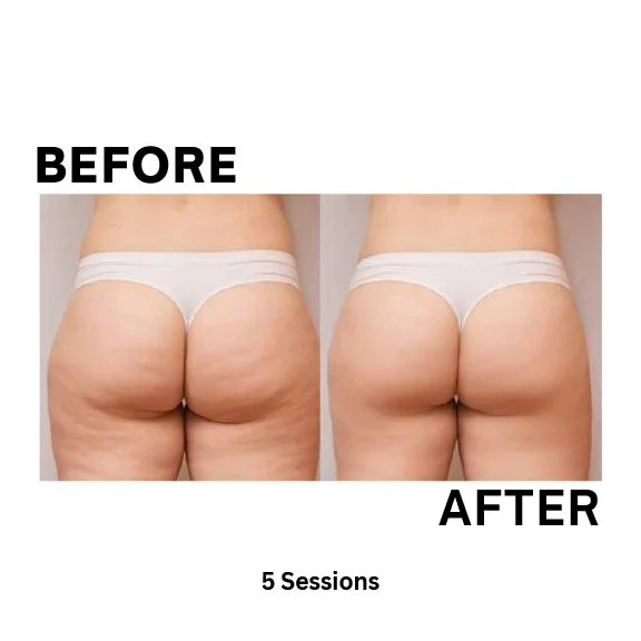Cryotherapy before and after , 5 Sessions