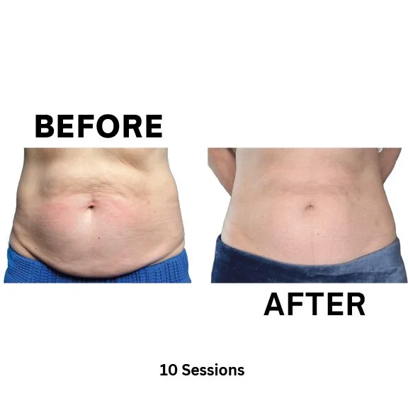 Cryotherapy before and after , 10 Sessions