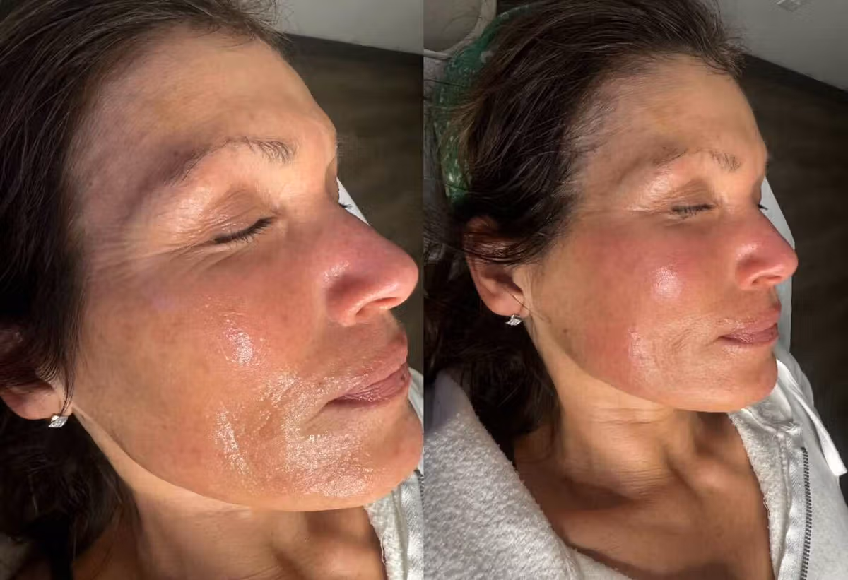Cryotherapy before and after , Body Sculpting Results