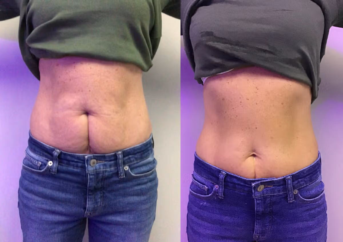 Cryotherapy before and after , Body Sculpting Results
